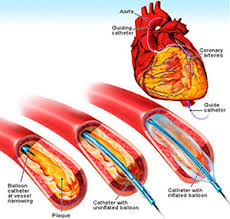 Open Heart Surgery in India-1