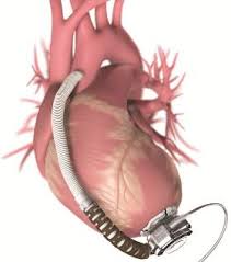 Ventricular Assist Device Surgery