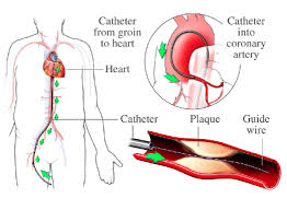 Angiography-4