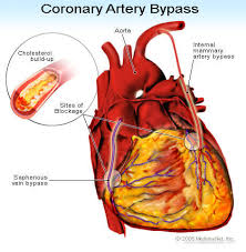 Cardiac artery bypass graft surgery