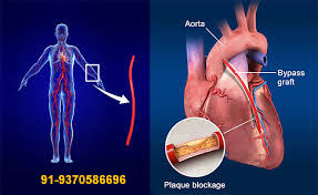 CABG Surgery in India copy