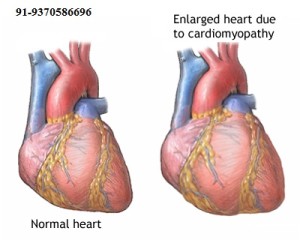HEART TRANSPLANT