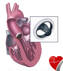 heart valve replacement copy