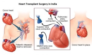 mcdc_heart-transplant-surgery-8col