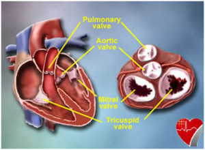 valve-repair-surgery-1 copy