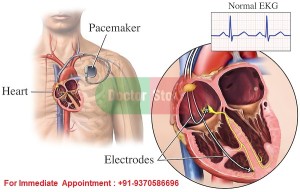 Pacemaker