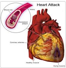 Open Heart Surgery in India