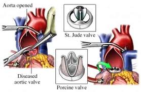 Mitral Valve Repair Cost in India 