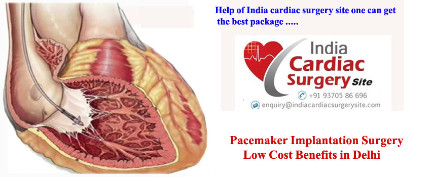 Pacemaker Implantation Surgery Low Cost Benefits in Delhi