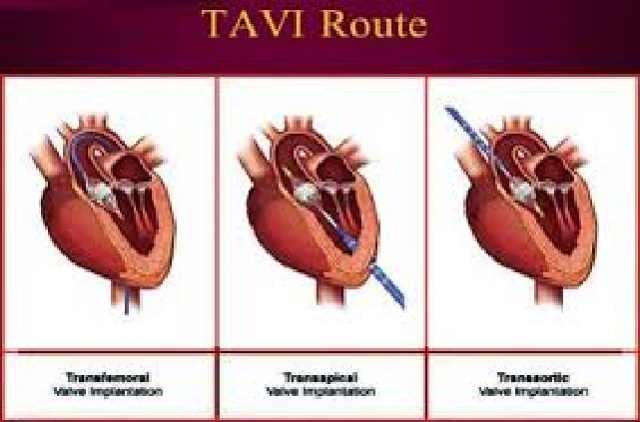 صمام الأورطى Tavi