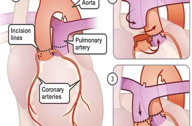 процедура артериального переключения