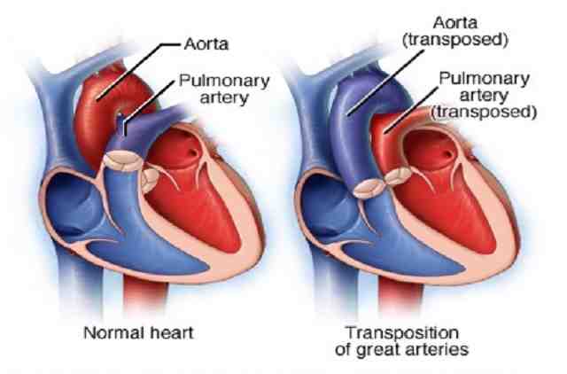 double outlet right ventricle