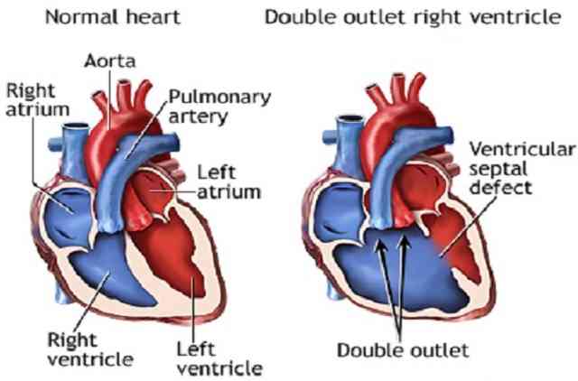 fontan and fontan type procedure