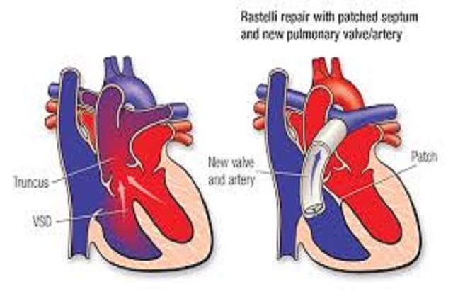 truncus arteriousus