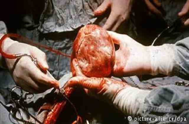 heart transpalent surgery