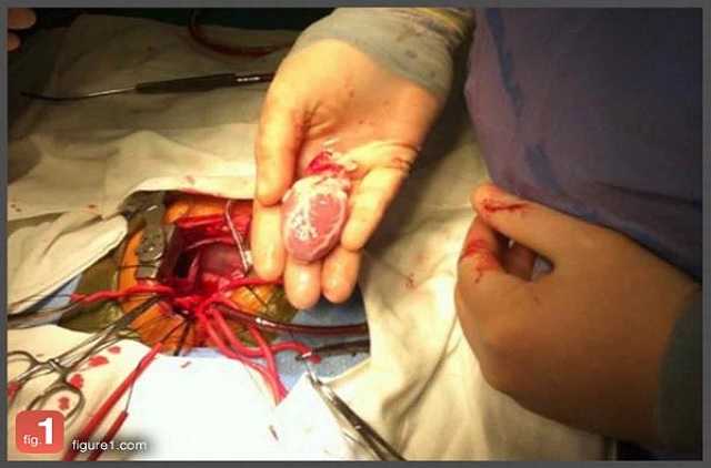 Transplantation cardiaque