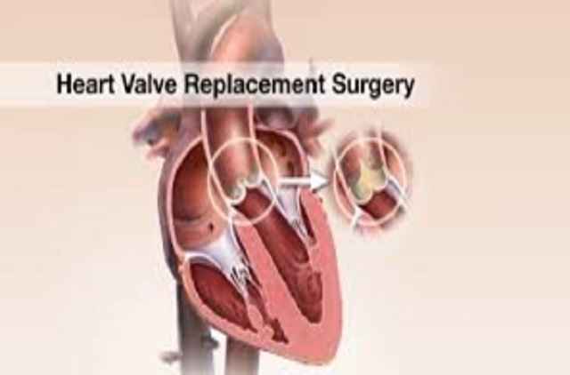 Remplacement de chirurgie valvulaire