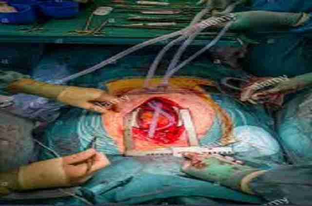 lung transplant