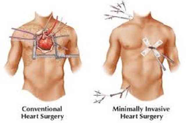 minimally invasive cardiac surgery