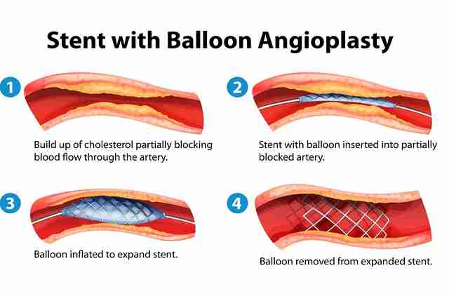 Angioplastie