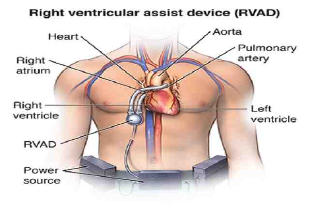Implantation de dispositifs d'assistance ventriculaire