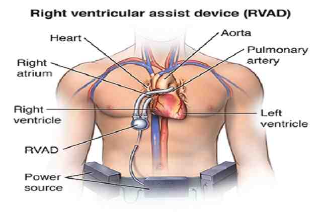 Ventricular সহায়তা ডিভাইস ইমপ্লান্ট