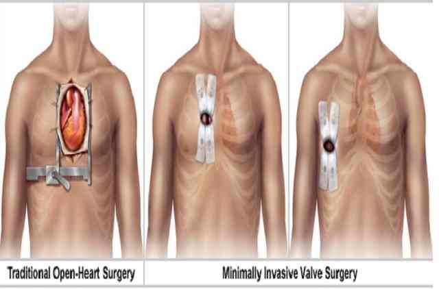 Minimally Invasive Valve Repair and Replacement