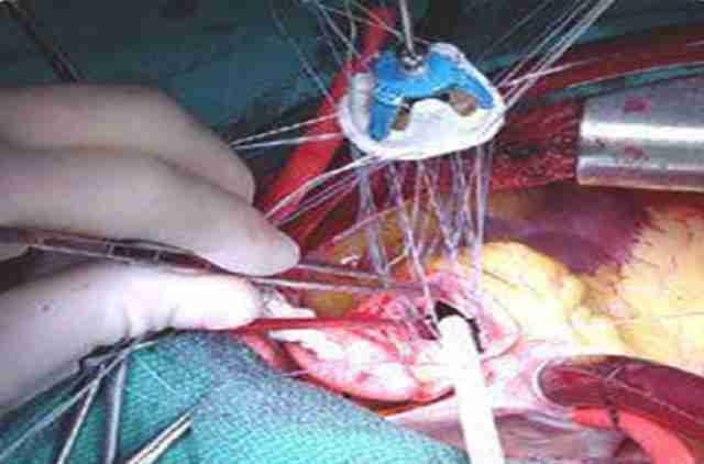 Chirurgie du pontage de l'artère coronaire sans pompe