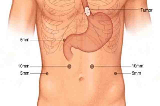 Chirurgie Thoracoscopique Minimalement Invasive