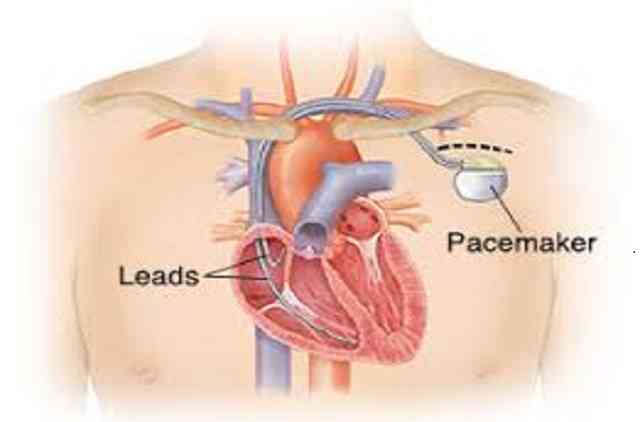 Pacemaker implantation
