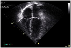 Echocardiogram