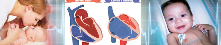 Why You Should Consider Ebstein Anomaly Surgery in India