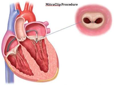 Mitral Clip Procedure