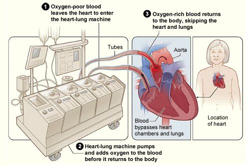 Total Artificial Hearts-VAD Total Artificial Hearts-VAD