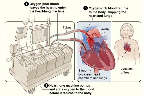 Total Artificial Hearts-VAD