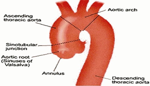 Bentall procedure