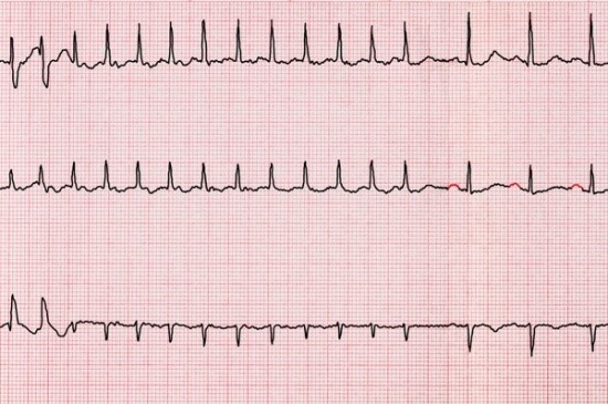 Echocardiogram