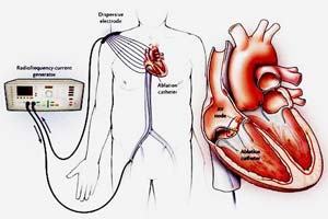 Affordable Catheter Ablation Procedure in India