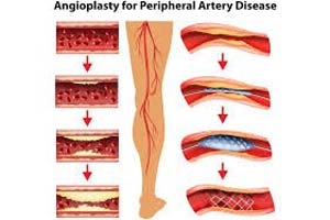 Affordable Coronary Angiography Test in India