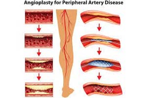 Affordable Coronary Angiography Test in India