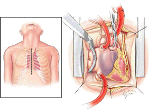 affordable maze surgery for atrial fibrillation in india