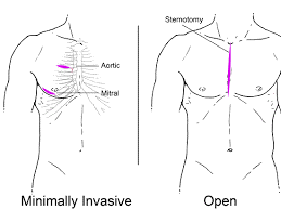 Chirurgie cardiaque mini-invasive abordable en Inde