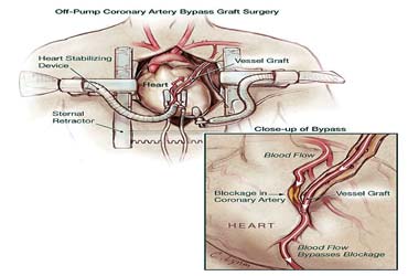 Affordable Off Pump Heart Surgery in India