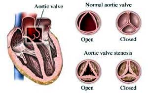 Chirurgie de réparation valvulaire aortique