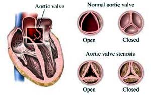 অওরটিক ভালভ মেরামত সার্জারি