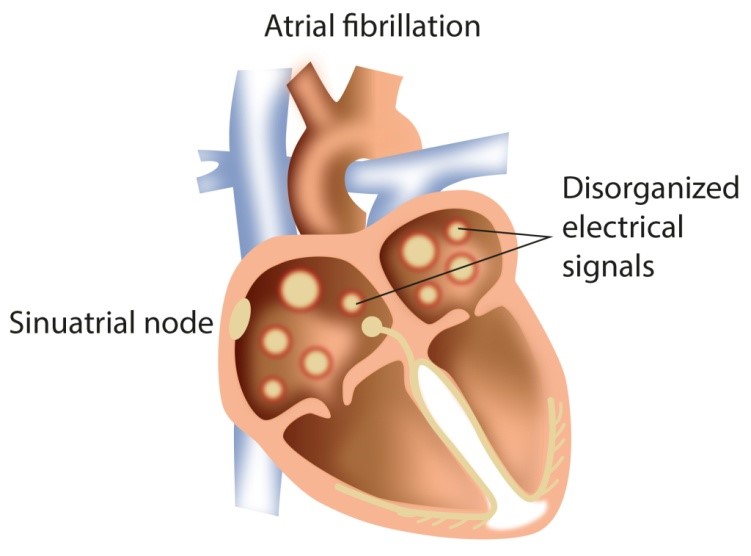 Atrial Fibrillation