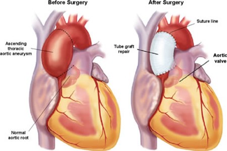 before and after Aneurysm repair