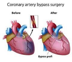 Meilleurs chirurgiens cardiaques pour la chirurgie de pontage cardiaque