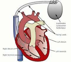 Best Cardiologist surgeon from ICD Implant