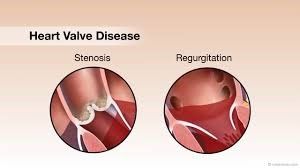 chirurgie de remplacement de la valve cardiaque en Inde